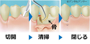 歯周外科手術（フラップ手術）の解説