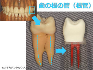 歯の神経の治療、根管の説明画像