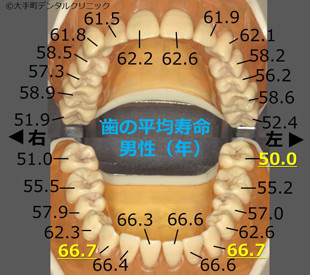永久歯の平均寿命（日本人男性）