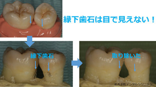 縁下歯石除去の治療前と治療後のイメージ画像