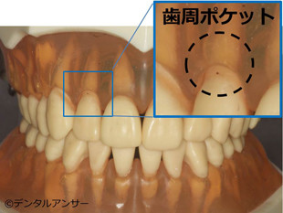 歯周ポケットの解説画像