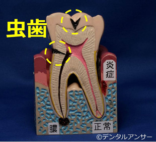 歯の痛みと虫歯の関係のイメージ