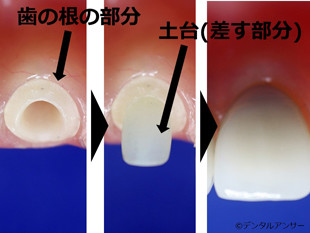 差し歯の解説画像