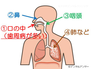 歯周病と口臭の関係のイメージの画像