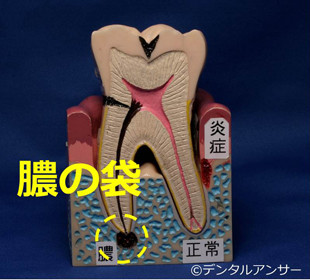 歯の痛みと膿の袋の関係のイメージ