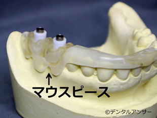 インプラントをする時の歯医者選びのポイント③マウスピースを使う