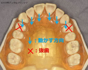 歯を抜いて矯正する方法の図