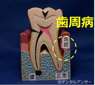 歯のグラつく原因（歯周病）