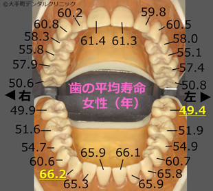 永久歯の平均寿命（日本人女性）