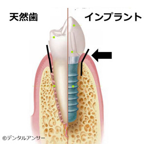 天然の歯とインプラントの形の違い