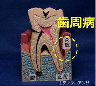 歯の痛みと歯周病の関係のイメージ