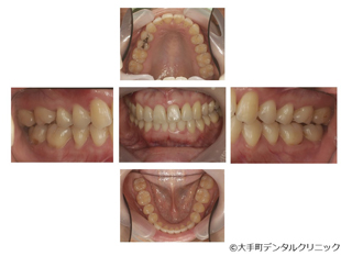 歯周病治療の順序（口腔内写真）
