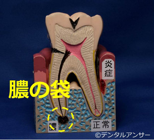 歯がグラつく、奥歯を噛むと痛い原因（膿の袋）