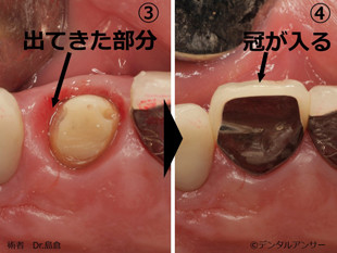 部分矯正歯牙（挺出）の実際の写真