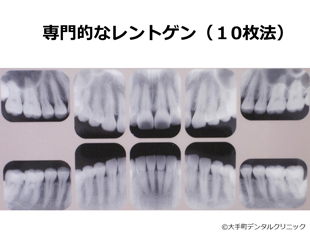 歯周病治療のための専門的なレントゲンの見本