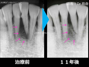 スウェーデン式歯周病治療の治療前と治療後の比較（下前歯）