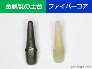 差し歯の土台の種類の比較