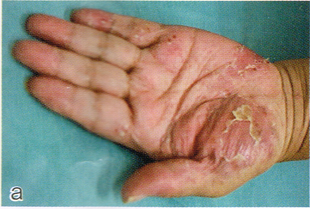 掌蹠膿疱症の写真（手のひら）
